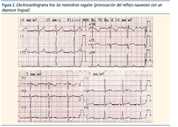 Figura 2. Electrocardiograma tras las maniobras vagales (provocación del reflejo nauseoso con un
depresor lingual).